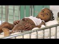 La lotta alla malnutrizione in Haiti all'Ospedale Pediatrico NPH Saint Damien